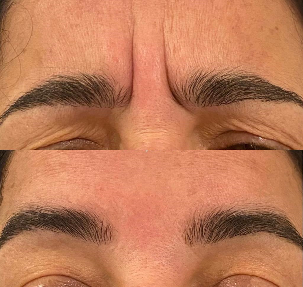 before and after anti-wrinkle
