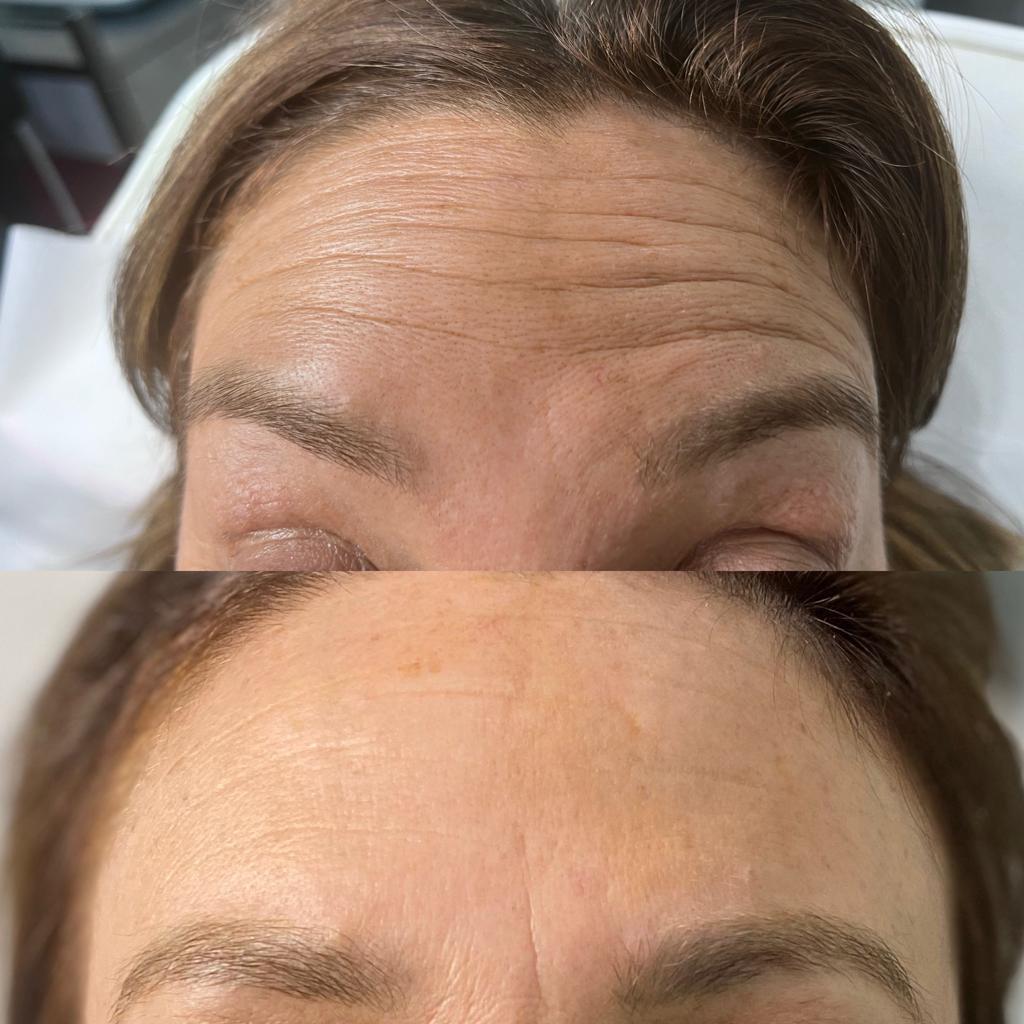 before and after anti-wrinkle