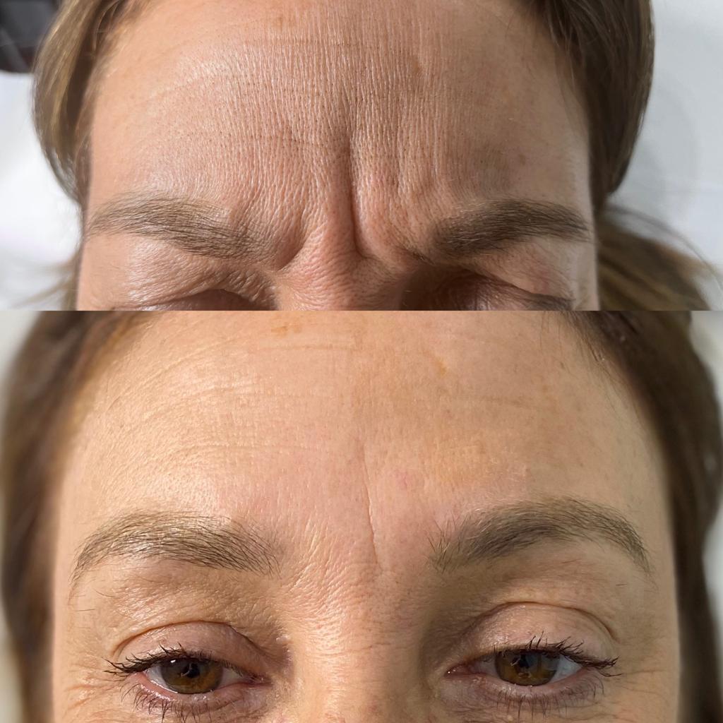 before and after anti-wrinkle