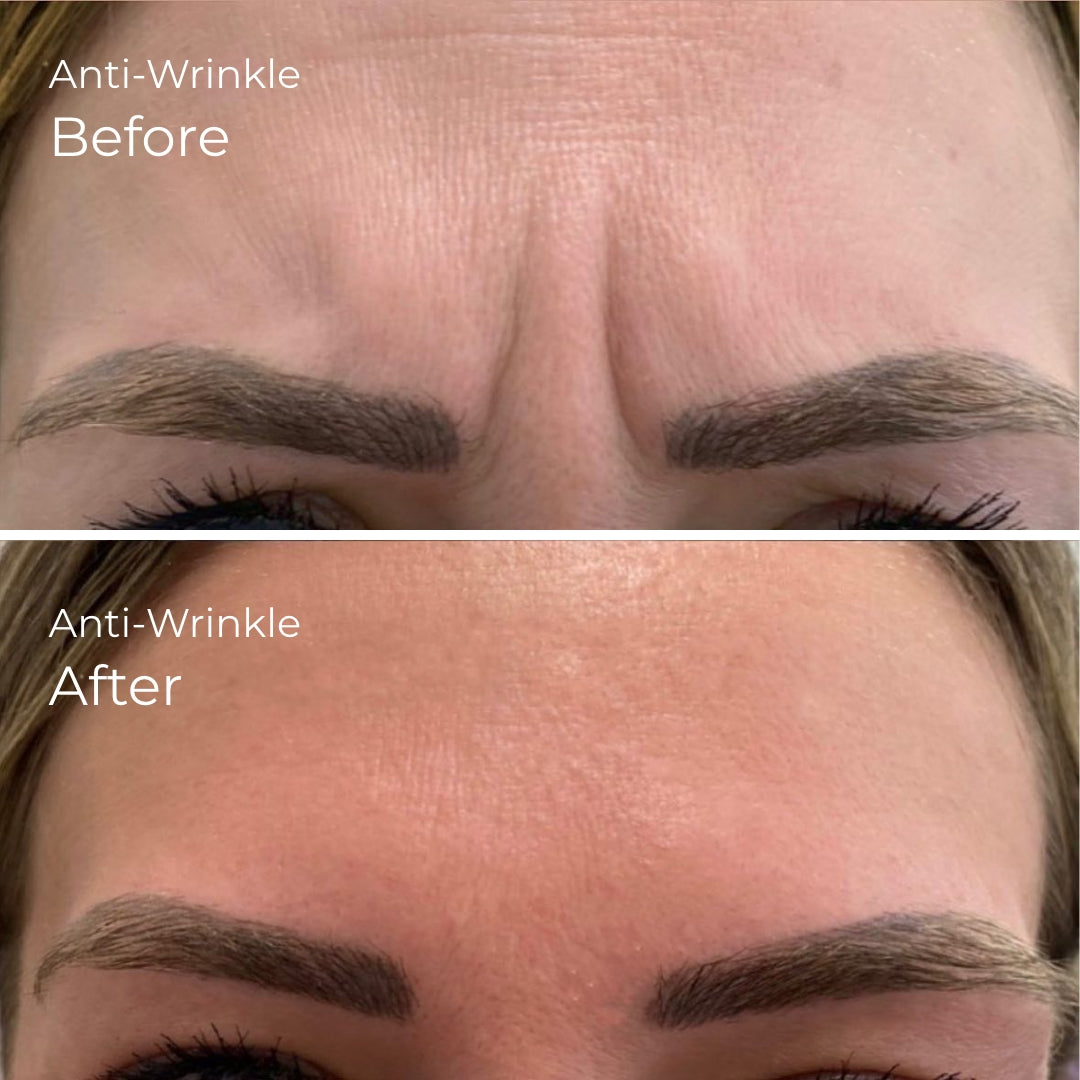 before and after anti-wrinkle