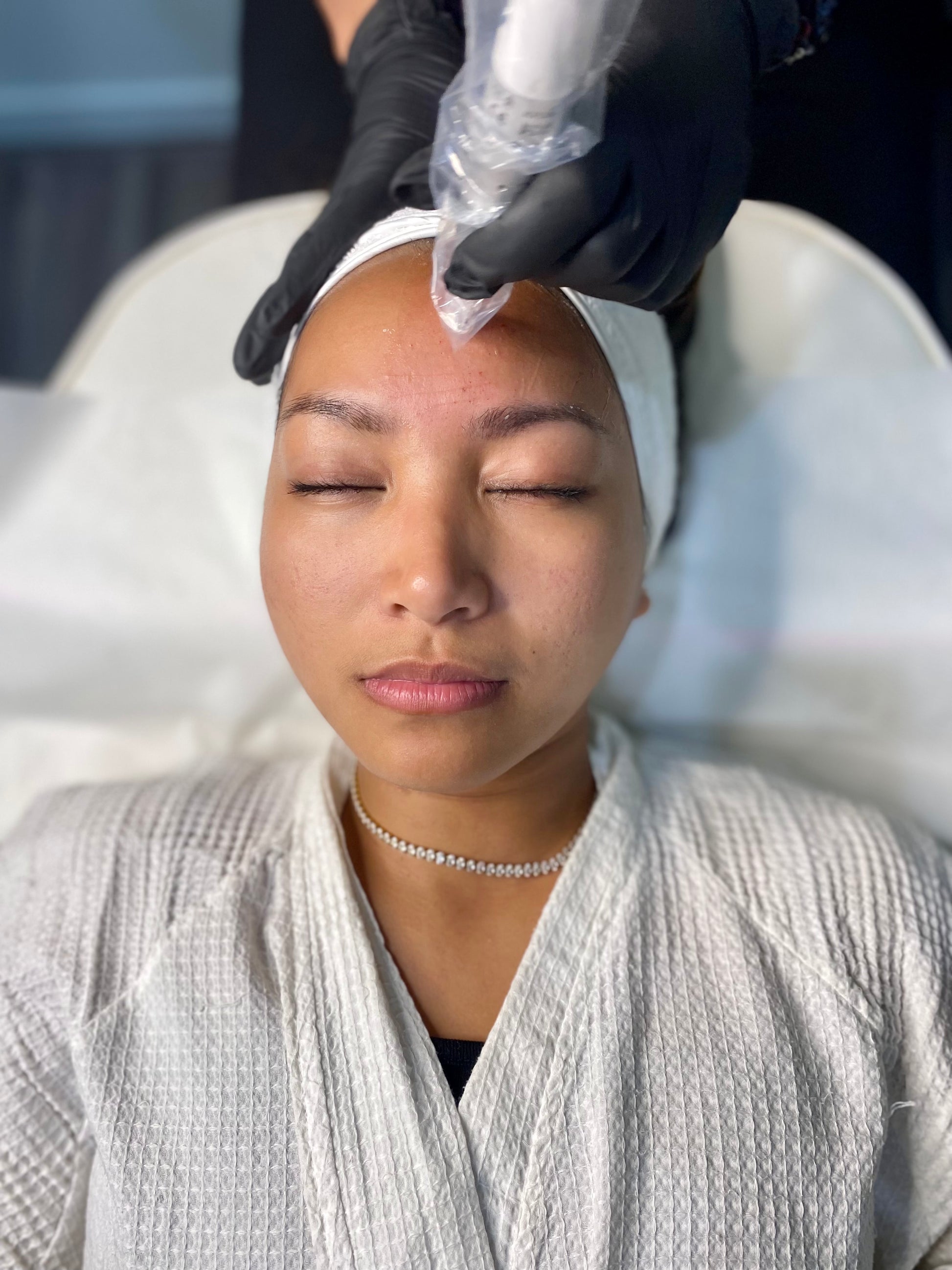 dermapen facial skin needling