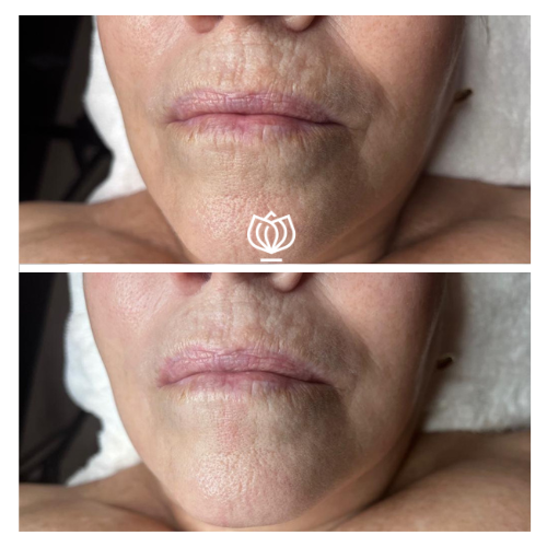before and after enzyme therapy mask