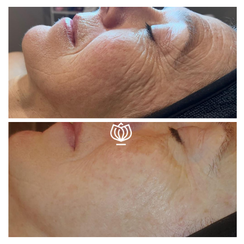 before and after enzyme therapy mask
