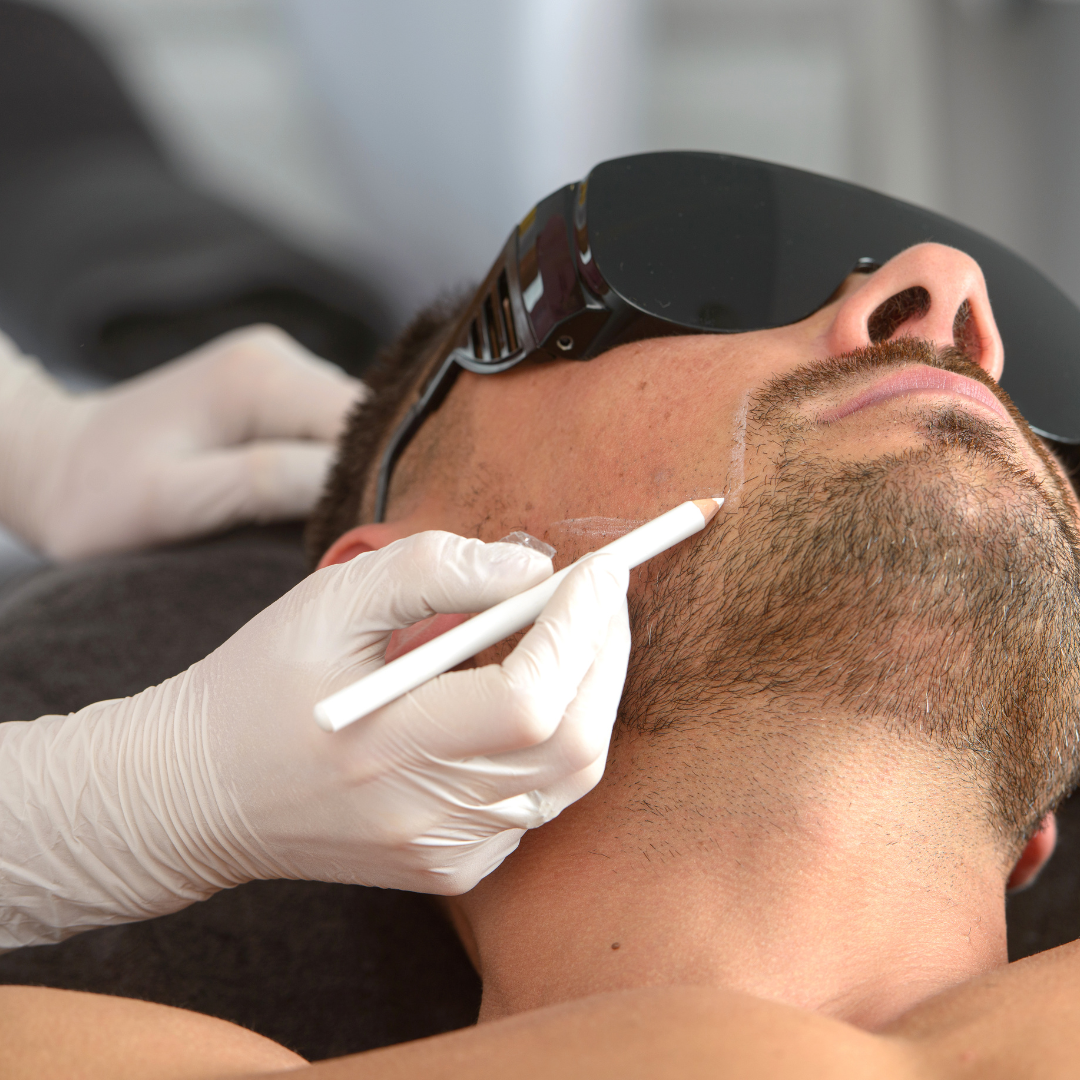 laser hair removal treatment