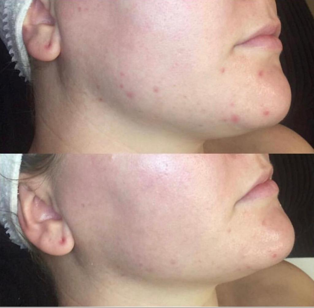 microdermabrasion before and after skin treatment