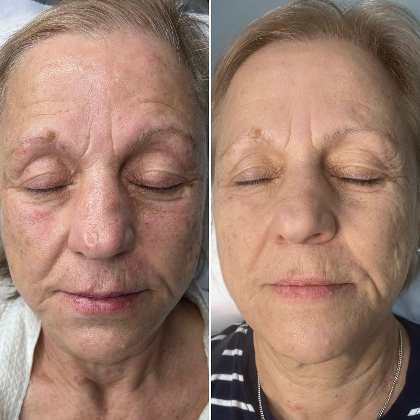 v2 skin booster before and after
