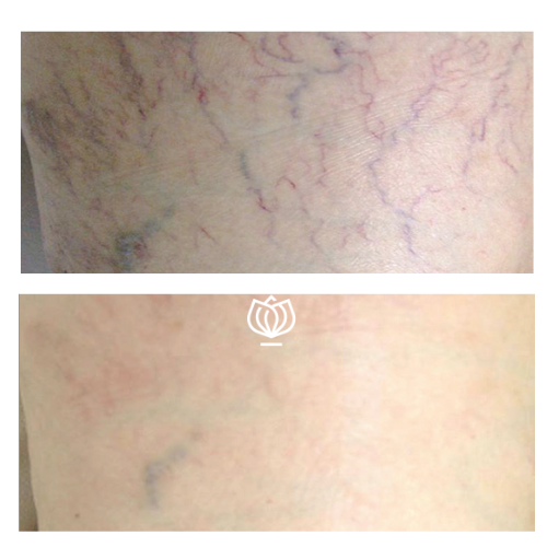 vascular before and after