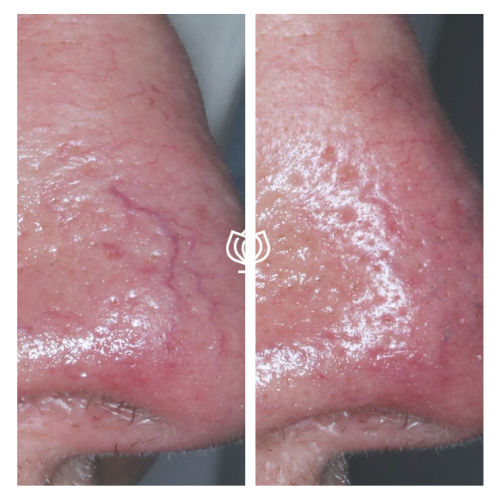 vascular before and after