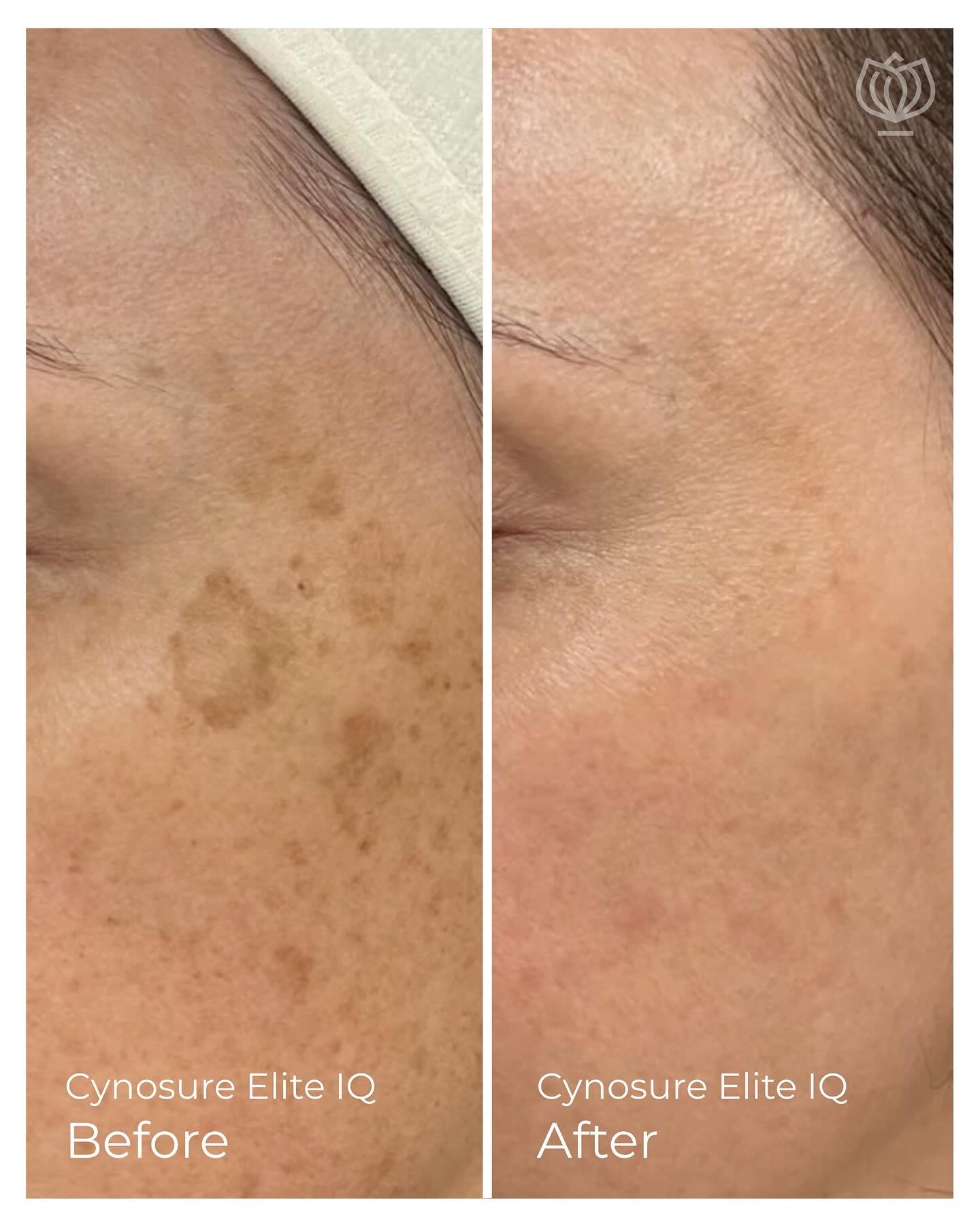 IPL Skin Treatments