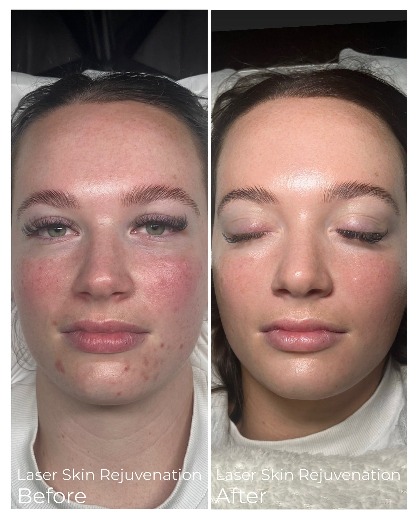IPL Skin Treatments